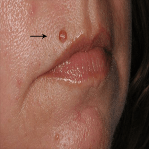 Cosmetic Mole Removal case