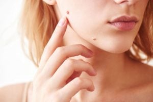 cosmetic more removal winston salem nc