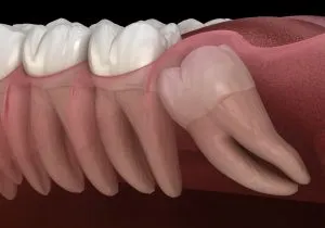 Uprighting Partially Impacted Permanent Second Molars north Carolina