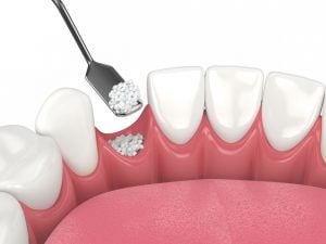 bone graft Kernersville NC