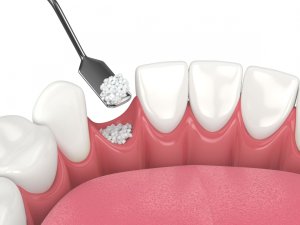 bone graft Kernersville NC