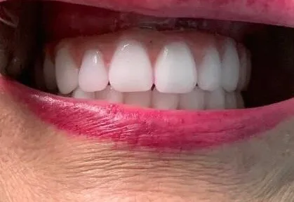 Final teeth look very natural