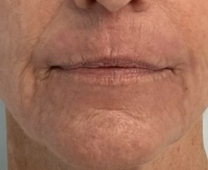 After Laser Skin Resurfacing