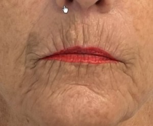 Before Laser Skin Resurfacing