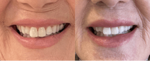 before and after subnasal lip lift transformation