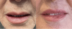 before and after lip lift  -  6 weeks  